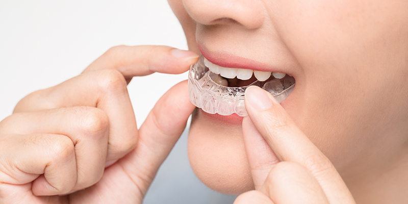 Invisalign – The Clear Path to a Straighter Smile